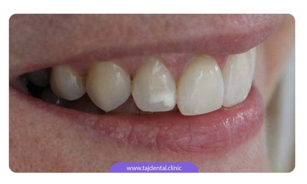 تصویر لکه سفید رنگ بر روی دندان ارتودنسی شده