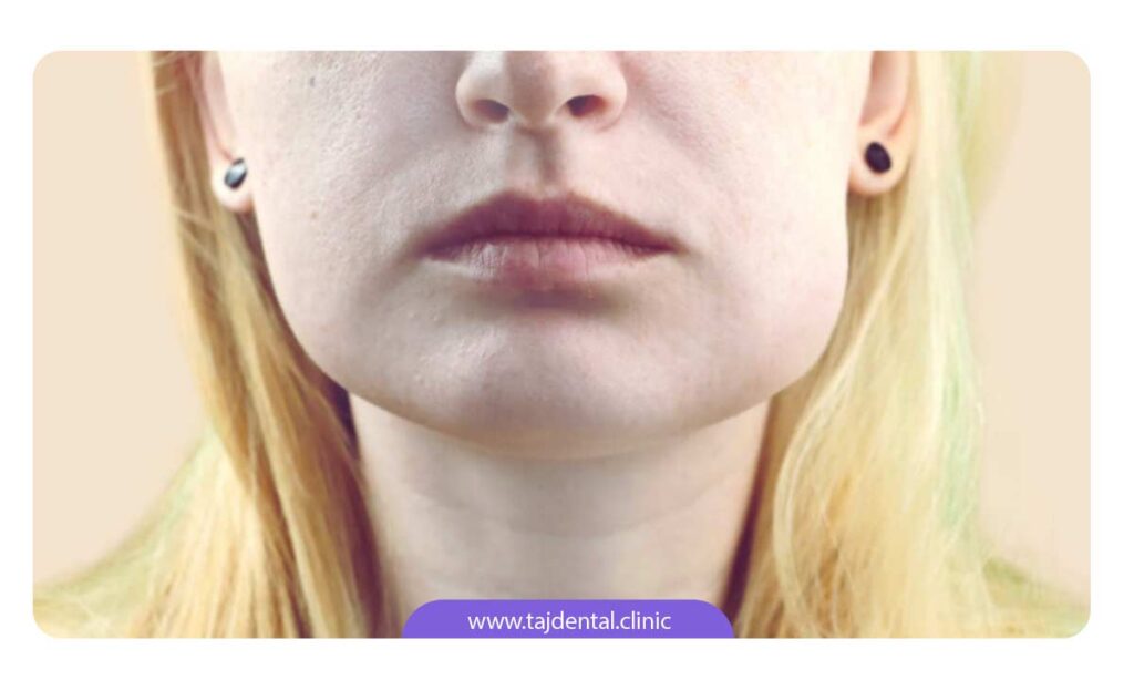 تصویر خانمی که به ورم صورت بعد از ایمپلنت دندان دچار شده است