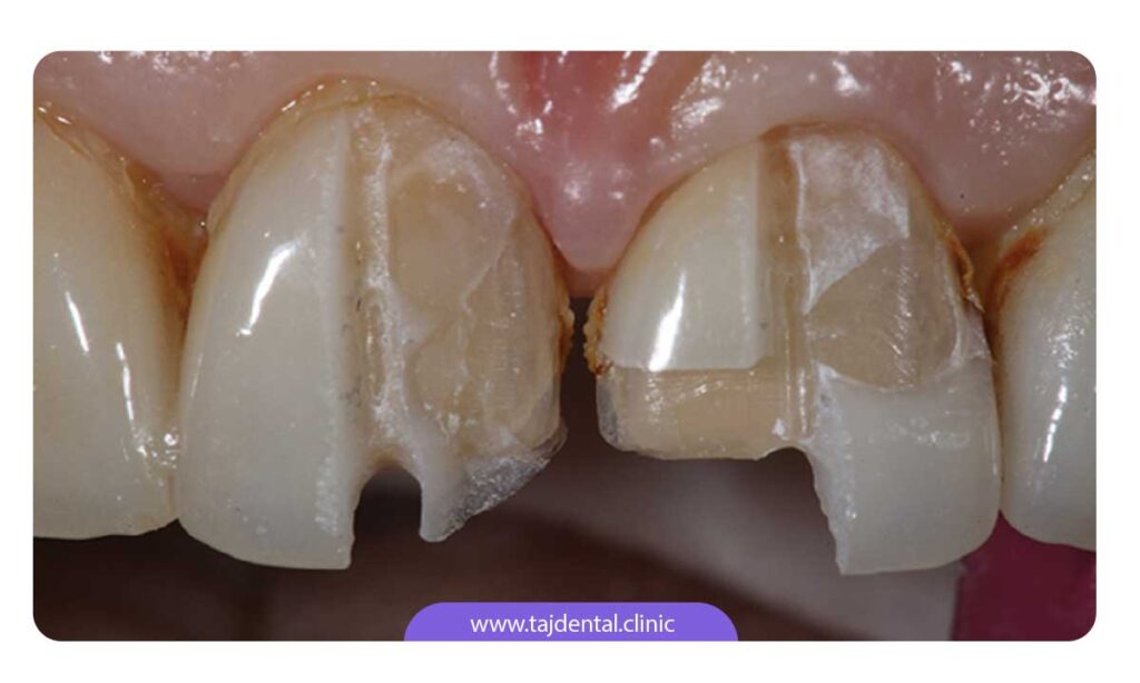 تصویر ظاهر دندان ها بعد از برداشتن لمینت دندان