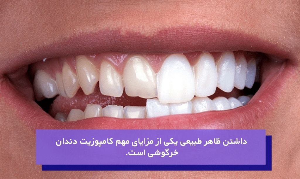 داشتن ظاهر طبیعی یکی از مزایای مهم کامپوزیت دندان خرگوشی