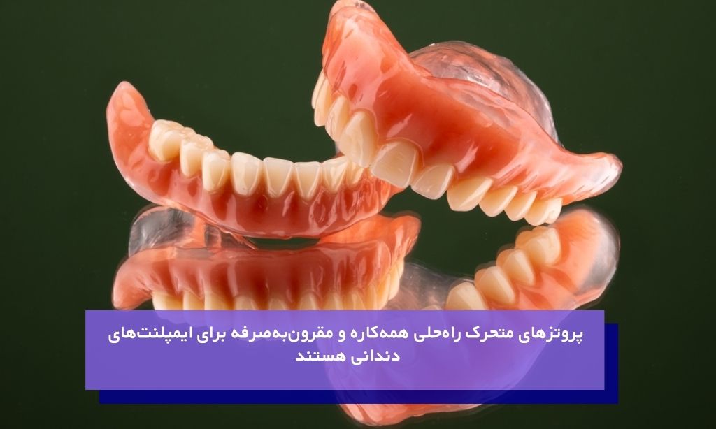 دندان مصنوعی جایگزینی برای ایمپلنت