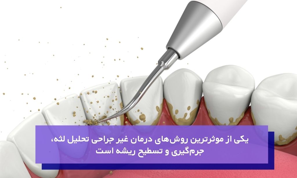 جرم‌گیری و تسطیح ریشه از موثرترین روش‌های درمان غیر جراحی تحلیل لثه