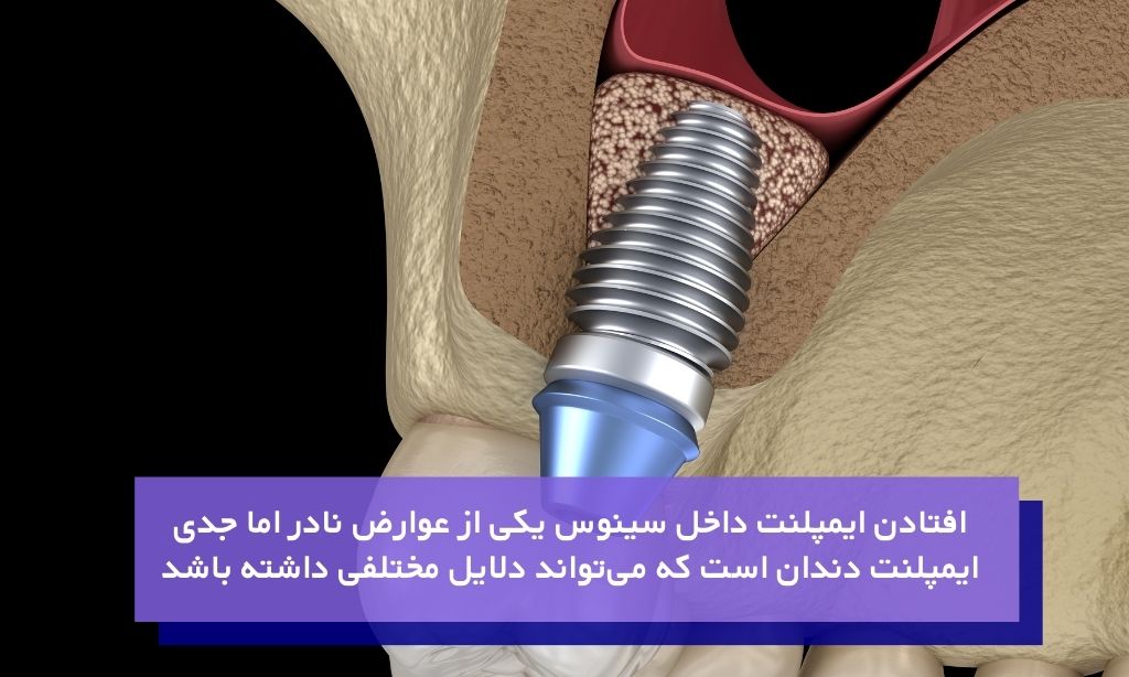 دلایل افتادن ایمپلنت داخل سینوس