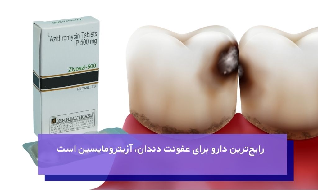 آزیترومایسین بهترین نوع دارو برای عفونت دندان