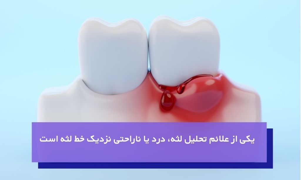 علائم تحلیل لثه