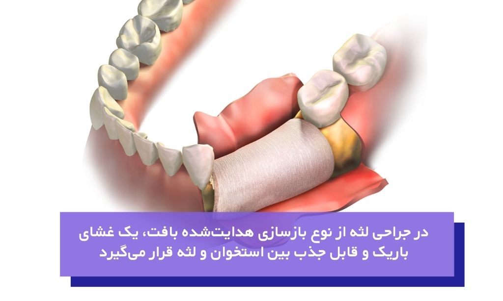 بازسازی هدایت‌شده بافت از تخصصی‌ترین انواع جراحی لثه