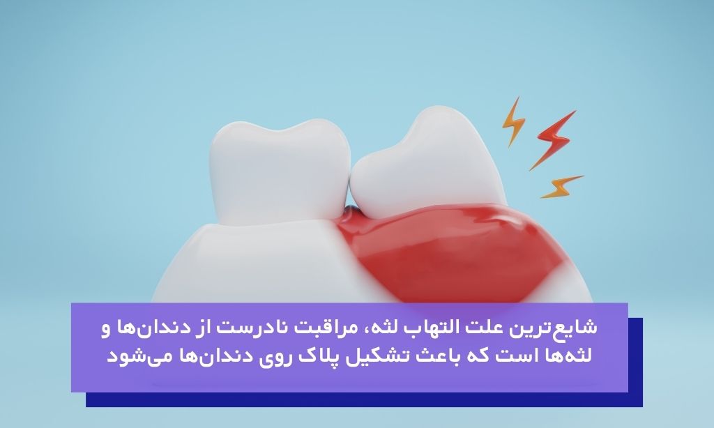 شایع‌ترین علت التهاب لثه