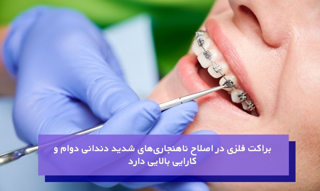 ارتودنسی ثابت با براکت فلزی