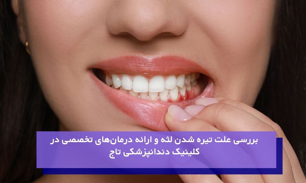 بررسی علت تیره شدن لثه و ارائه درمان‌های تخصصی