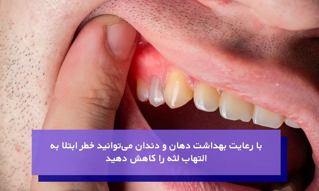 پیشگیری از التهاب لثه