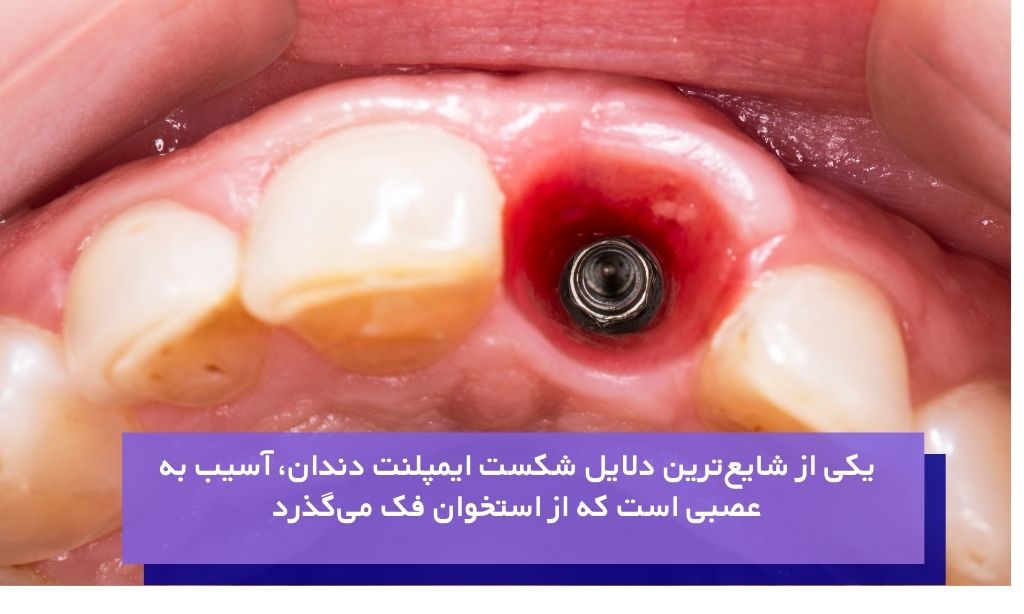 عصب آسیب دیده از شایع‌ترین دلیل شکست ایمپلنت دندان