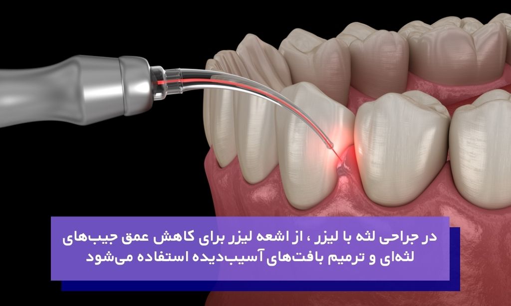 جراحی لثه با لیزر