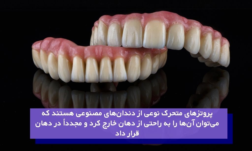 پروتزهای متحرک