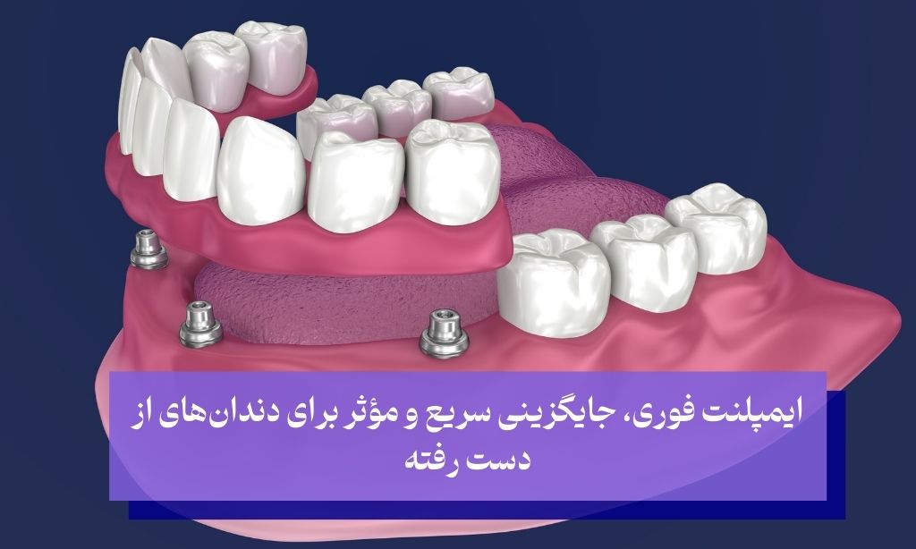 ایمپلنت فوری