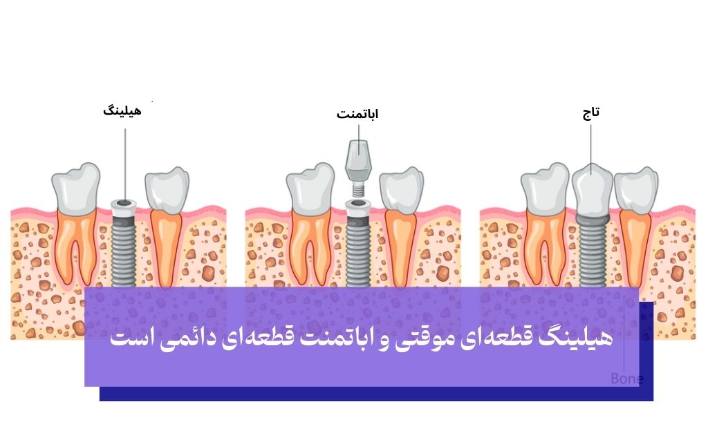 فرق هیلینگ و اباتمنت