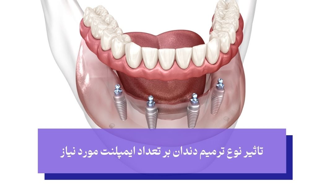 تاثیر نوع بازسازی و ترمیم بر تعداد ایمپلنت دندان