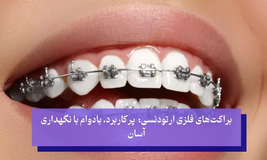 عکس براکت ارتودنسی فلزی