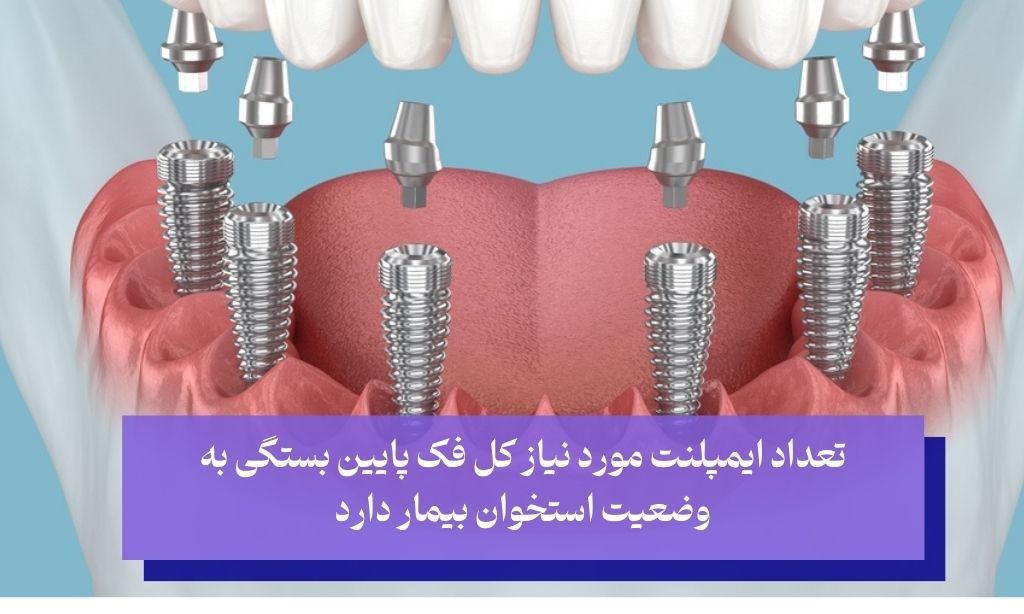 تعداد مورد نیاز ایمپلنت کل فک پایین بستگی به وضعیت استخوان بیمار