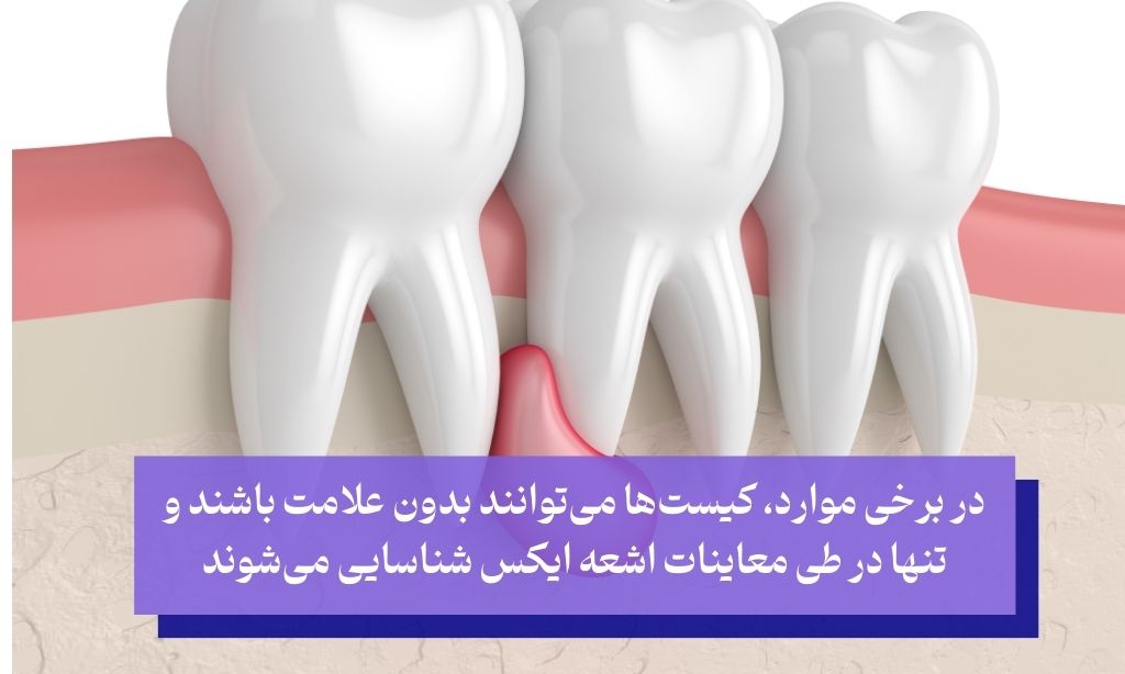 علائم کیست‌های دندانی