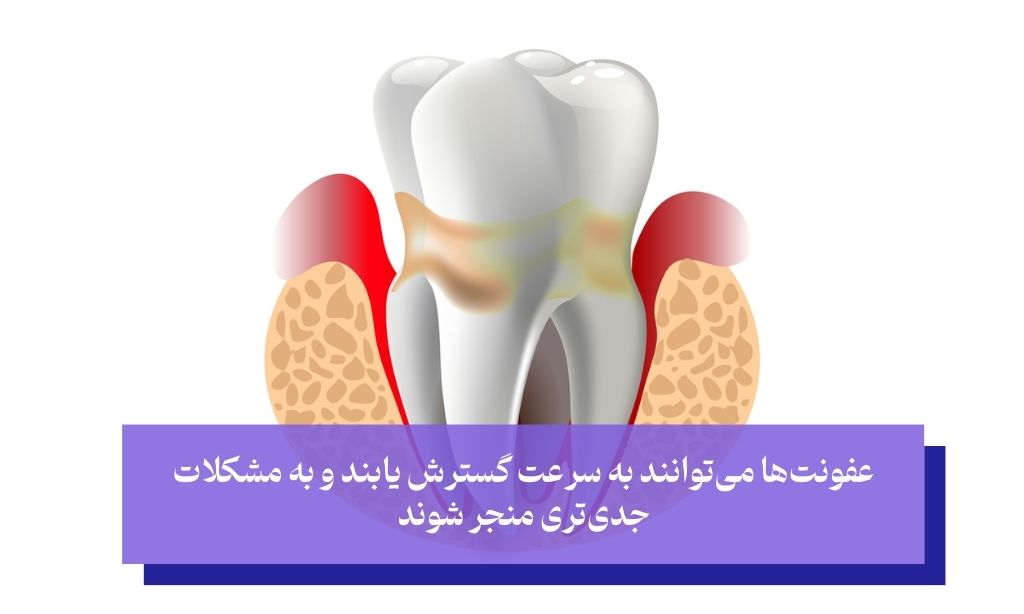 مهار عفونت‌های عمیق دندانی با قرص متروماکس 