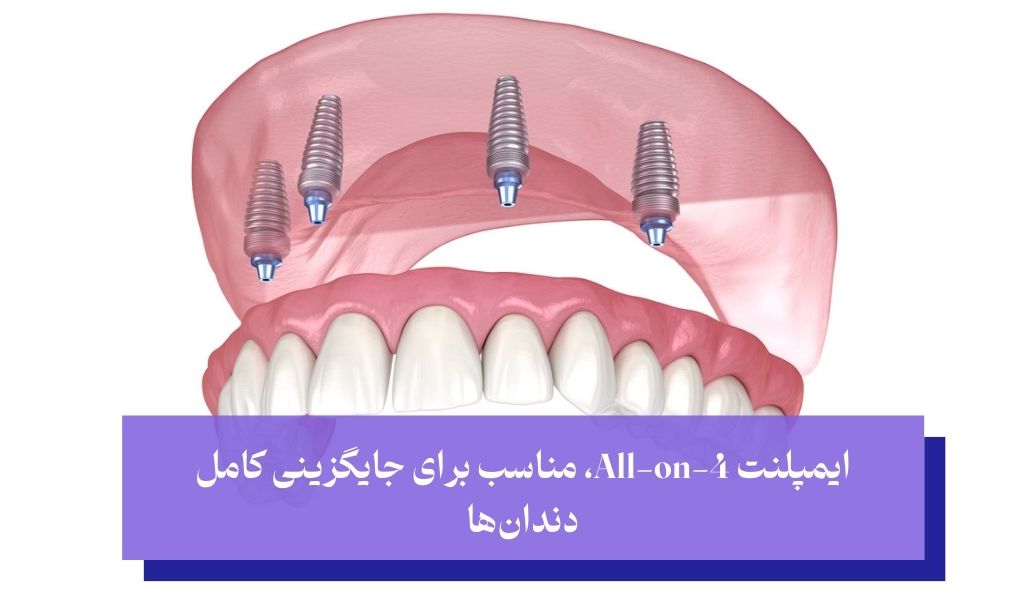 ایمپلنت All-on-4