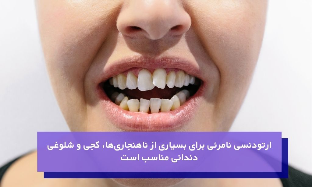 ارتودنسی نامرئی برای چه دندان هایی مناسب است