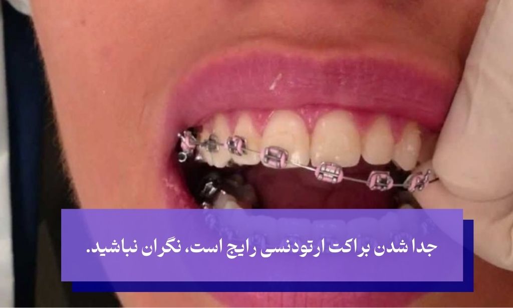 مراجعه به دندانپزشک برای درست کردن براکت کنده شده