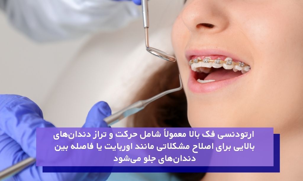 مراحل ارتودنسی فک بالا