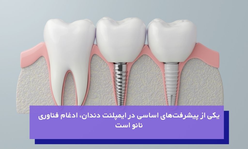 پیشرفت‌های اساسی در تکنولوژی ایمپلنت‌ دندان