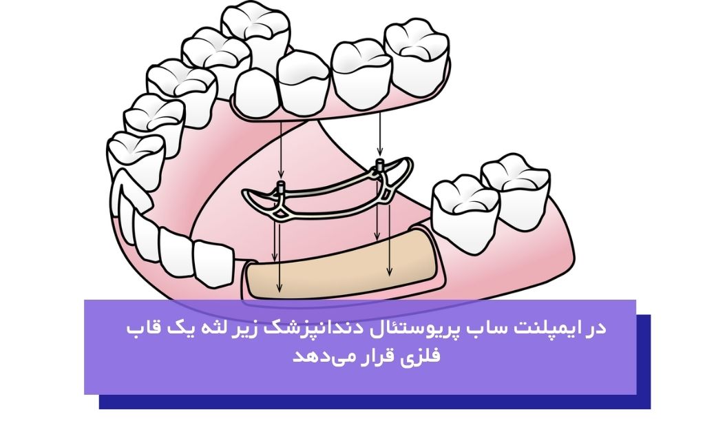 ایمپلنت ساب پریوستئال