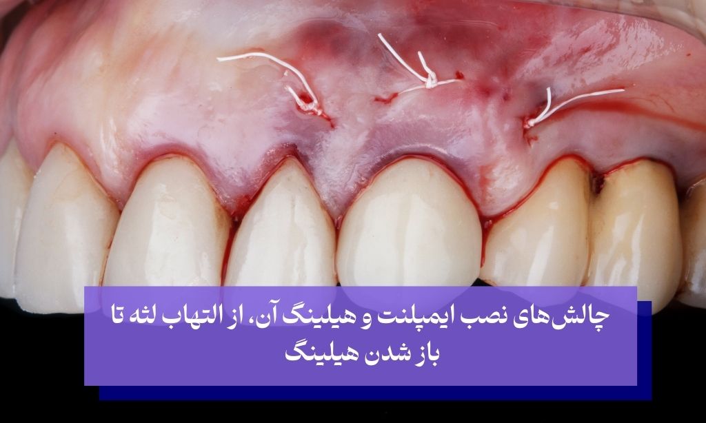 چالش‌های مرتبط با هیلینگ