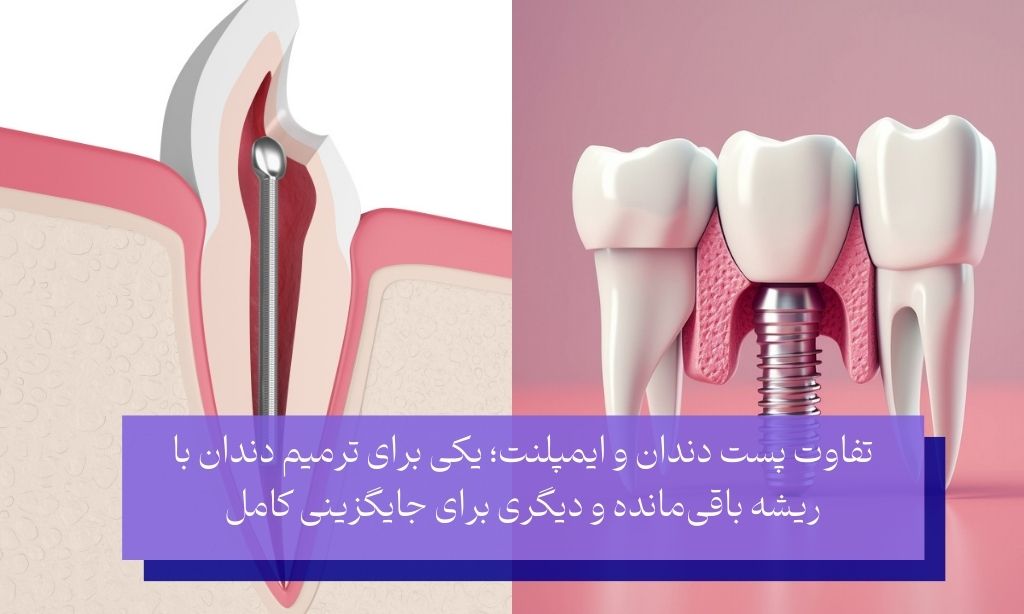 تفاوت پست دندان و ایمپلنت