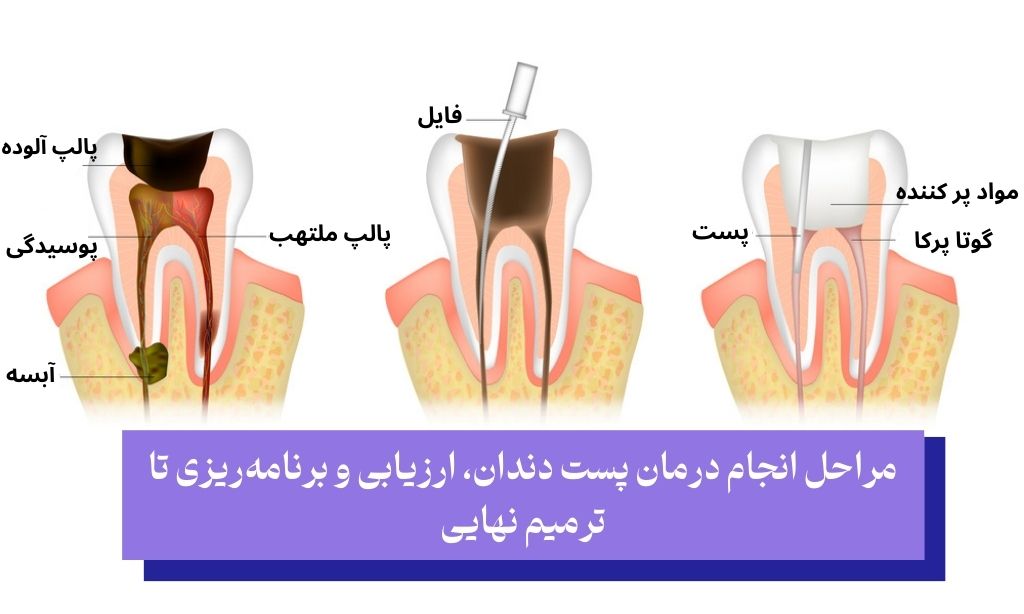 مراحل انجام درمان پست