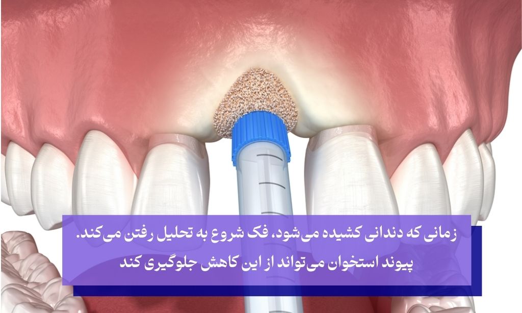 چه زمانی پیوند استخوان ضروری است