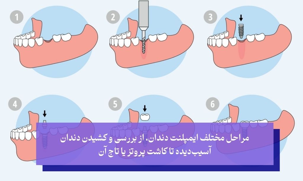 مراحل ایمپلنت دندان