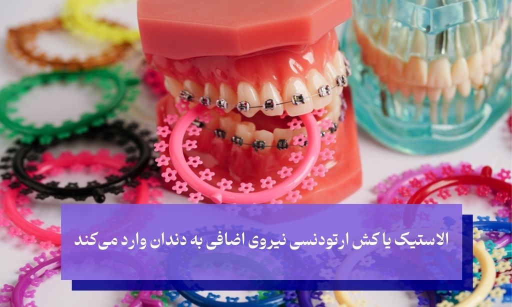 کش ارتودنسی چگونه کار می‌کند