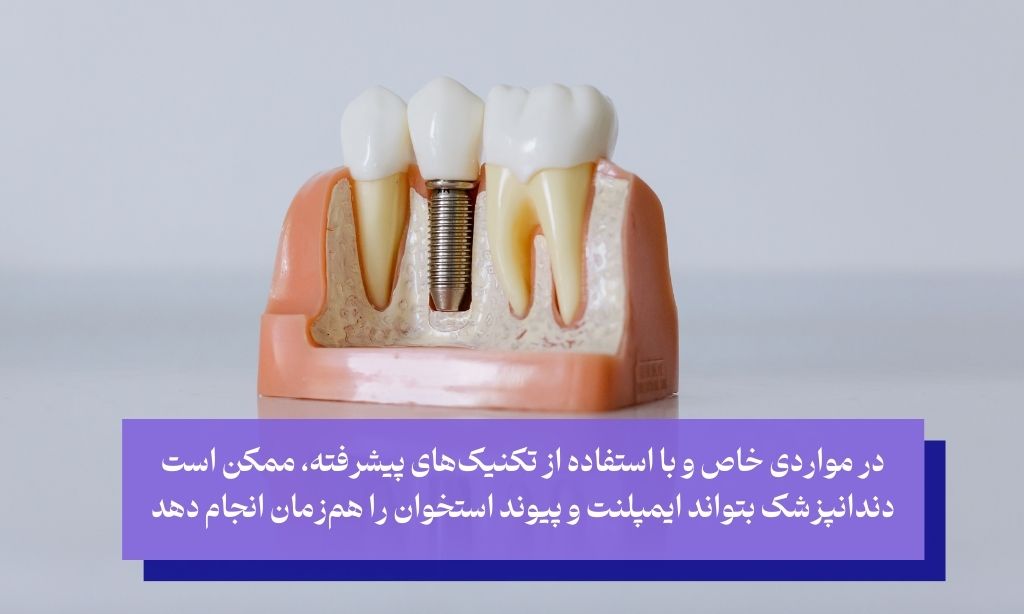 ایمپلنت دندان پس از پیوند استخوان