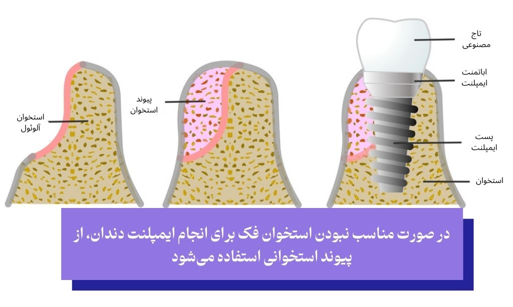 پیوند استخوان سخت‌ ترین مرحله ایمپلنت