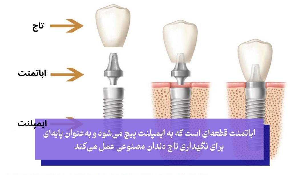 مرحله قرار دادن اباتمنت