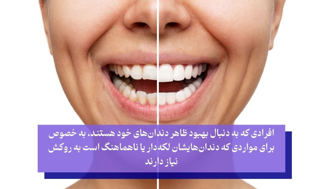 ‌چه کسانی برای روکش دندان سرامیکی مناسب هستند