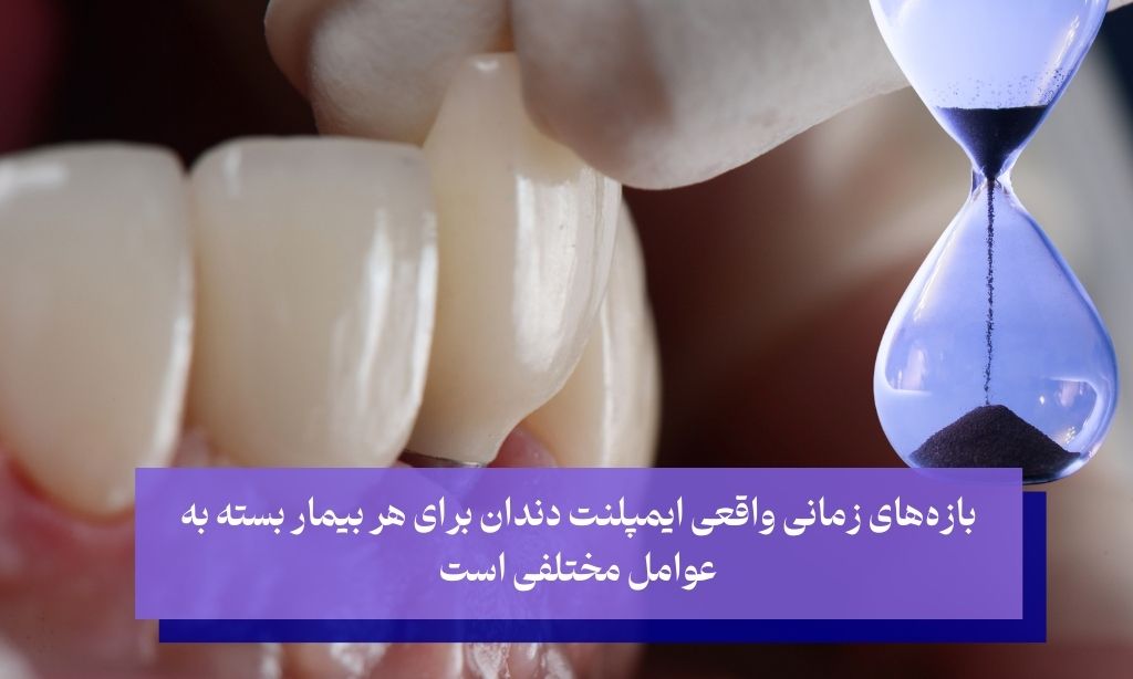 زمانبدی کاشت ایمپلنت دندان