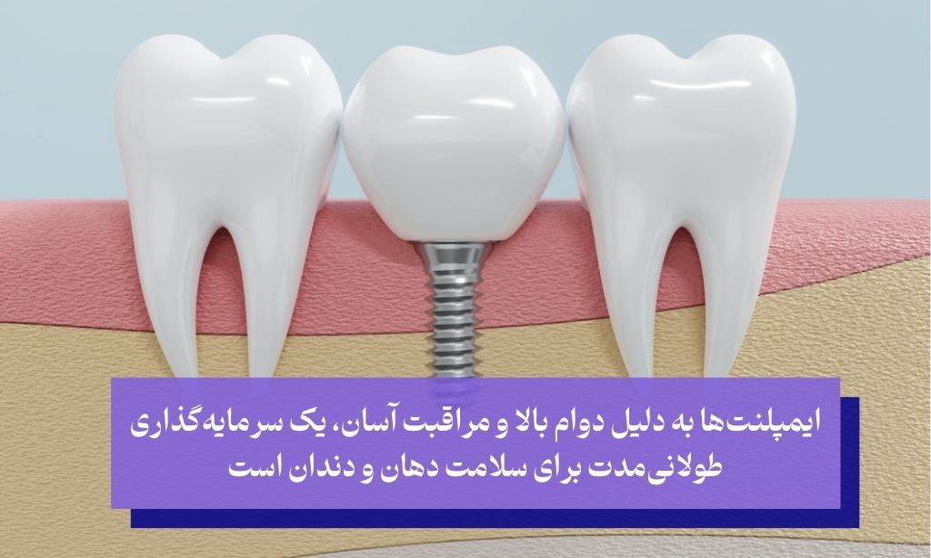 ایمپلنت دندان یکی از روش های مدرن زیبایی دندان