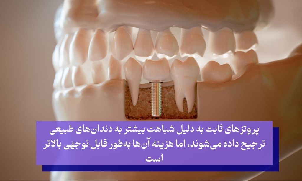 نوع پروتز نهایی فاکتور مهم در تعیین قیمت ایمپلنت کامل فک بالا و پایین