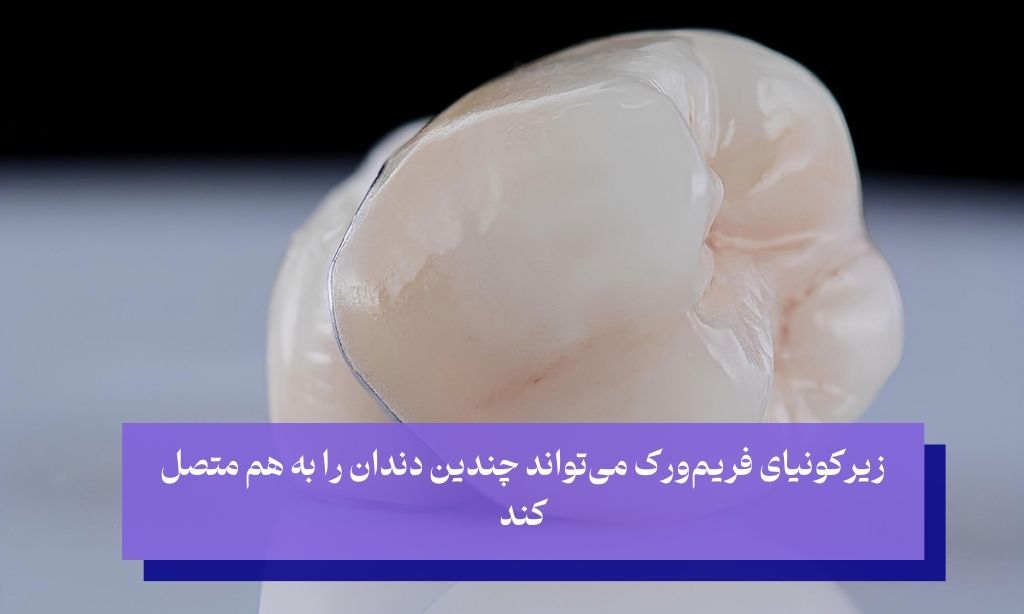 روکش زیرکونیای فریم‌ورک