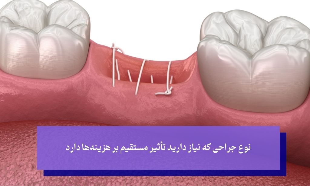 نوع جراخی از عوامل موثر بر هزینه جراحی لثه 