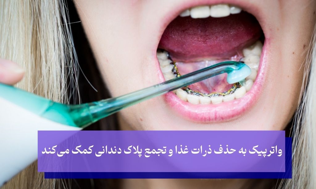 استفاده از واتر پیک برای تمیز کردن ارتودنسی