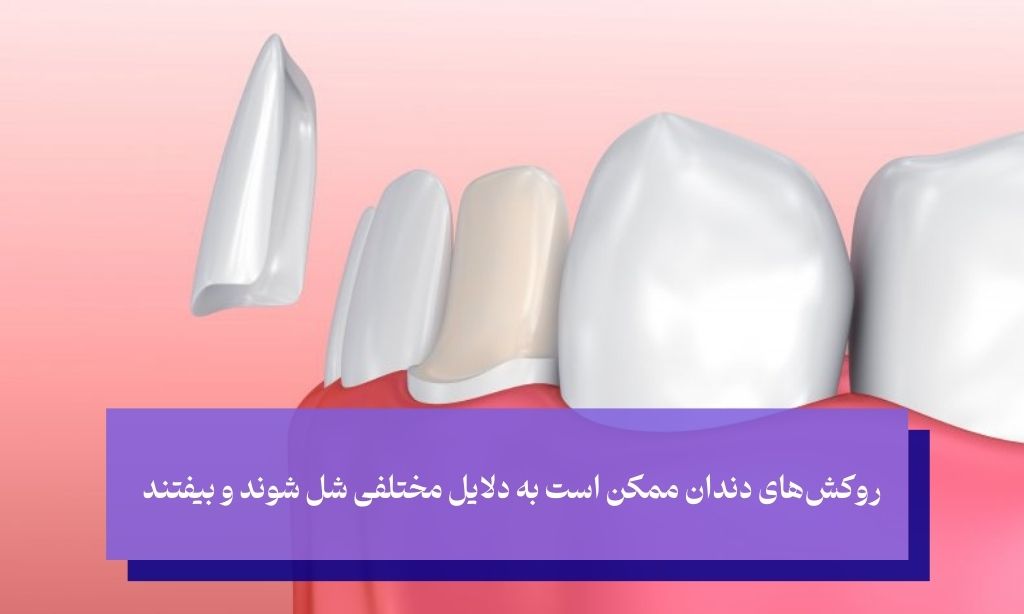 افتادن روکش دندان