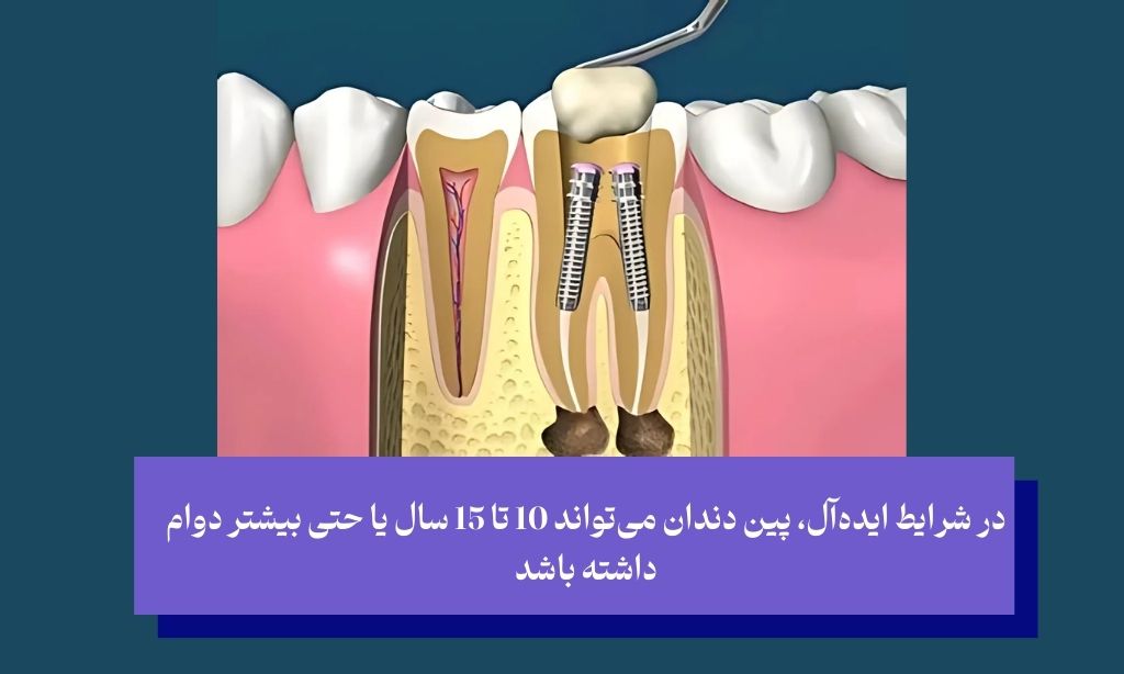 عمر پین دندان چقدر است