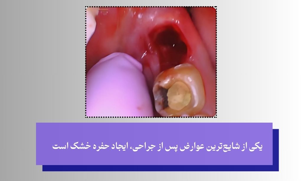 عوارض احتمالی پس از جراحی دندان عقل