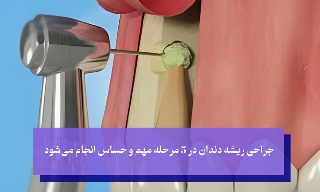 مراحل جراحی ریشه دندان